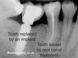 Root Canal Therapy