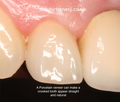 Porcelain Veneers